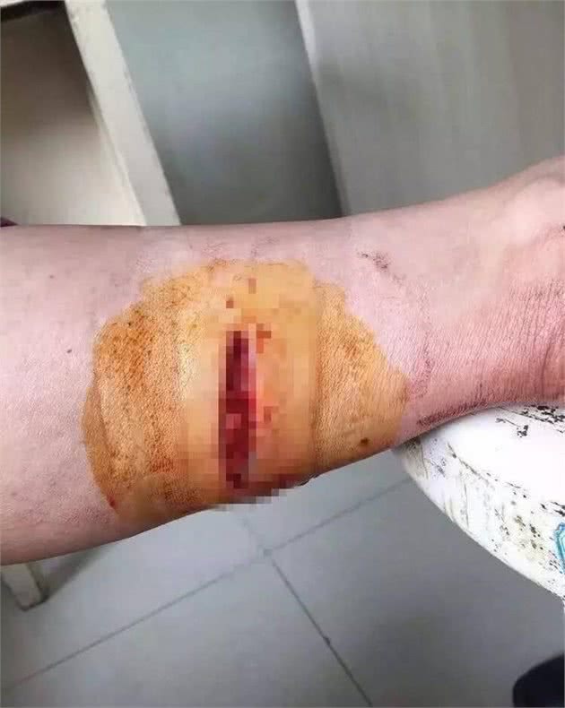 为救人,金华9岁男孩打死疯狗!而他却被咬伤