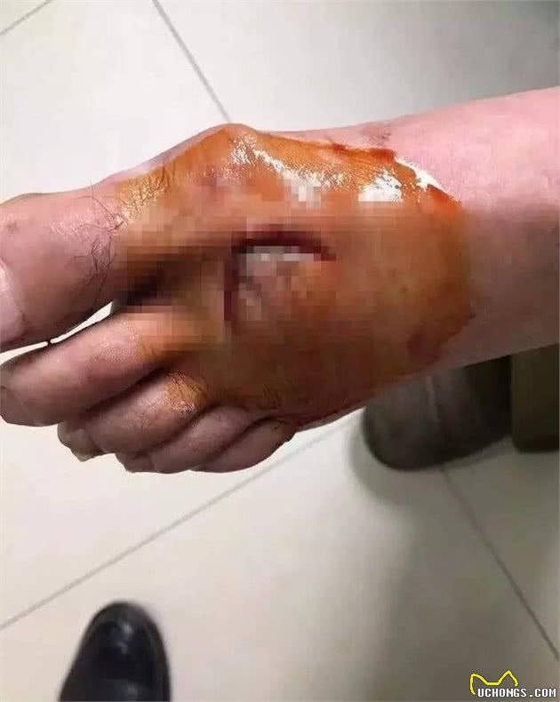 为救人,金华9岁男孩打死疯狗!而他却被咬伤
