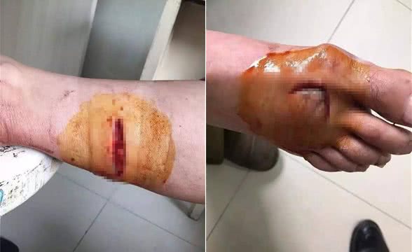 为救人，金华9岁男孩打死疯狗！而他却被咬伤