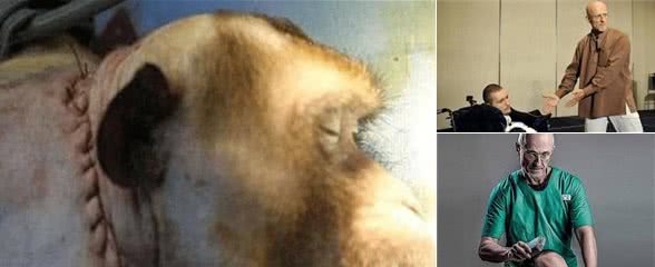 狗换头手术成功，首例活体换人头手术找到志愿者，最终结果如何