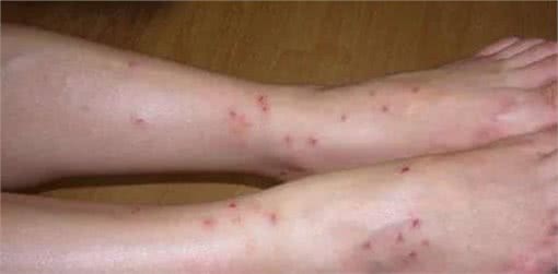 宠物毛发里长的一种小动物非常讨厌，人被叮咬后奇痒无比